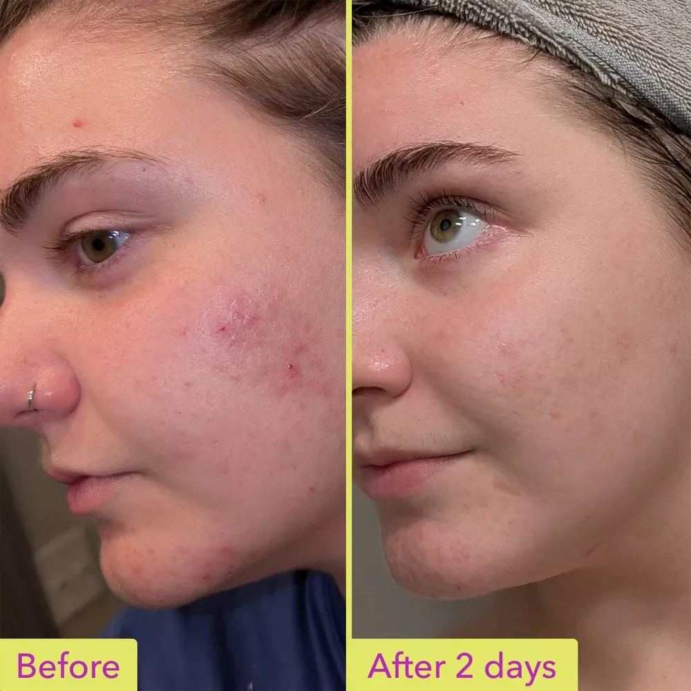 ★ GOOD MOLECULES 10% AZELAIC ACID TREATMENT 30ML ★  | USA EXCLUSIVE – photo 3