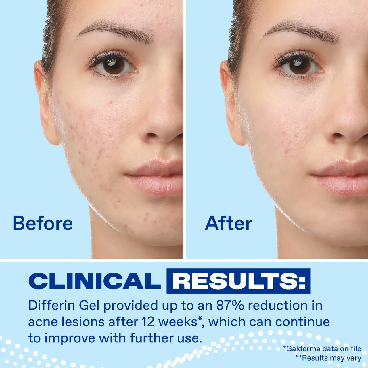 ★ DIFFERIN ADAPALENE GEL 0.1% ACNE TREATMENT 45G ★ | USA EXCLUSIVE | – photo 5